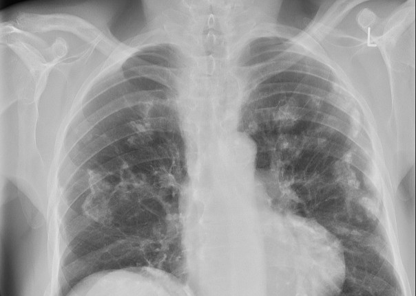 Asbes Dalam Perspektif Medis