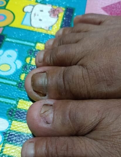 Kuku buruh yang mulai rusak akibat pestisida